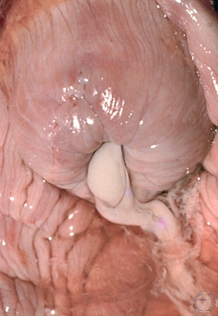 Cervical Discharge.