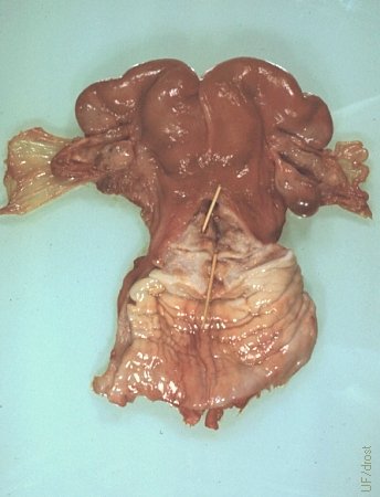 Cervical Stenosis.