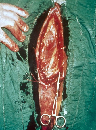 External Abdominal Oblique Muscle Incision.