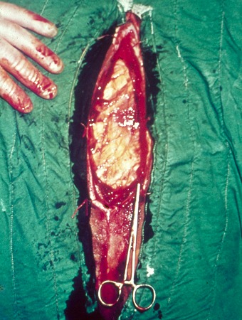 Internal Abdominal Oblique Muscle Incision.