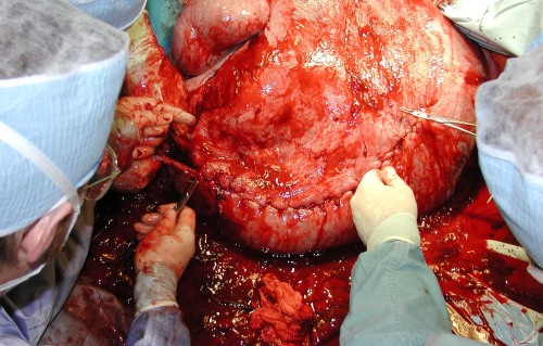 Suturing the Emphysematous Uterus.