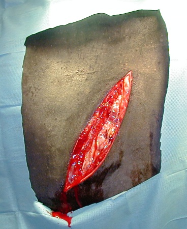Skin and Muscle Incision.