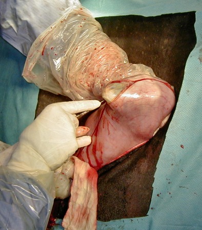 Start of the Uterine Incision.