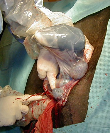 Extending the Uterine Incision.