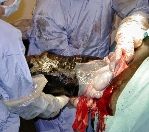 Extraction of the Fetus.