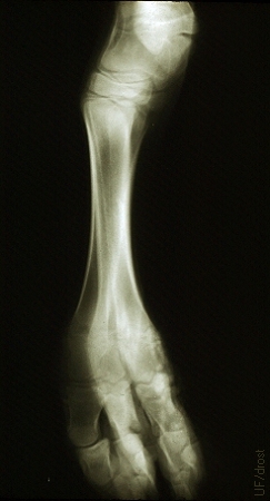 Radiograph of Duplication of Bones.