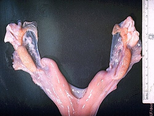 Hypoplasia of Female Reproductive Tract.