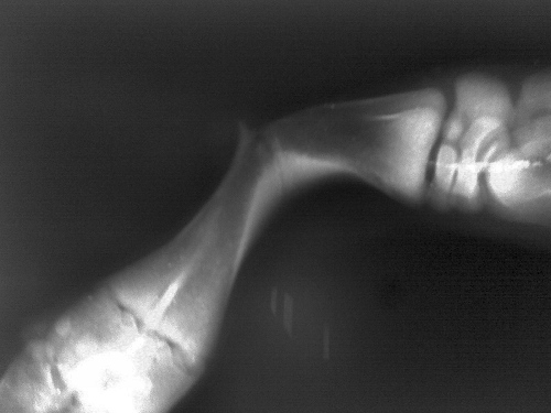Radiograph of a Fetal Fracture.