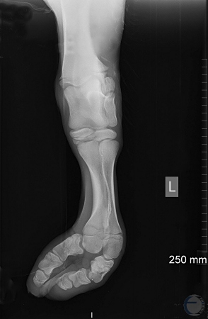 Severe Digital Subluxation - X-ray.