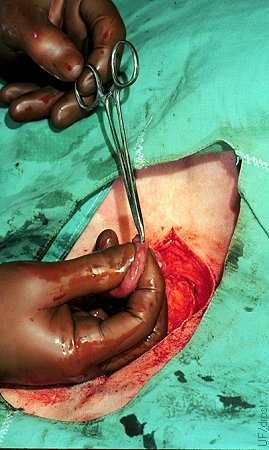 Site of Surgical Transfer.