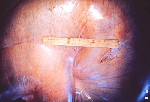 Tightly Distended Uterus due to Hydrallantois.