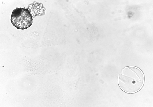 IVF Hatched Blastocyst and Zona.