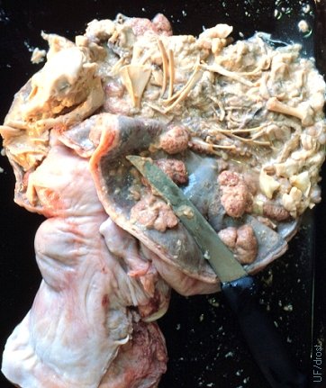 Complete Maceration of 4-5 Month Old Fetus.