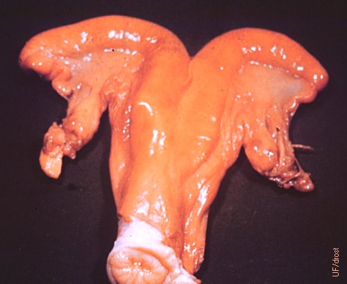 Macerated Bones in the Uterus.