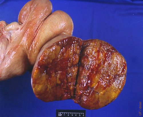 Solid Granulosa Cell Tumor.