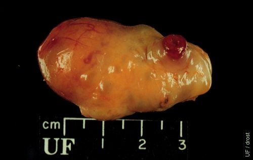 Accessory Corpus Luteum.