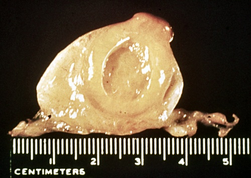 Cystic Corpus Luteum.