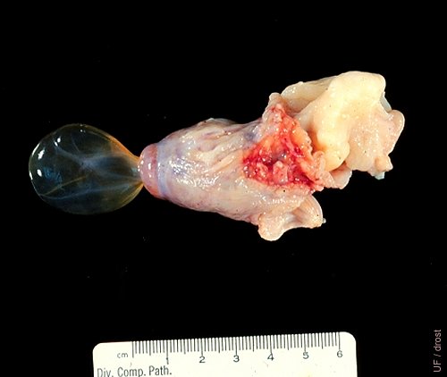 Peritoneal Inclusion Cyst.