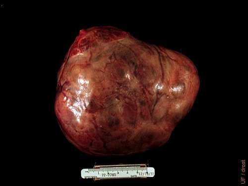 Cystic Granulosa Cell Tumor.