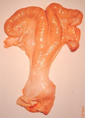 Cystic Corpus Luteum.