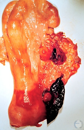 Enucleation of the Corpus Luteum.