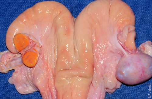Ovarian Cyst.
