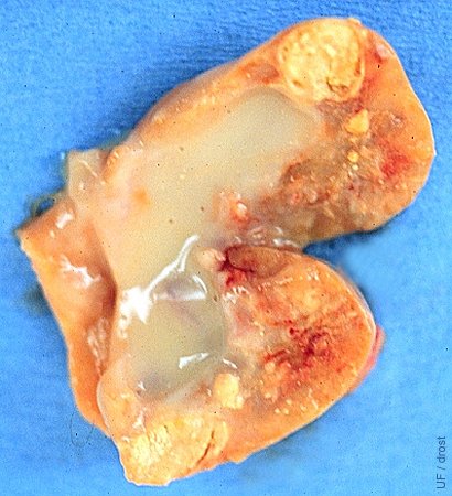 Intraovarian Abscess.