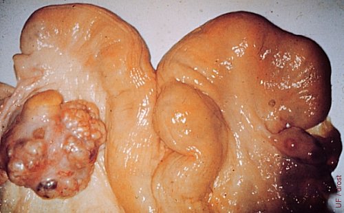 Small Granulosa Cell Tumor.