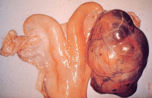 Large Granulosa Cell Tumor.