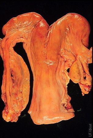 Ovarian Hypoplasia.