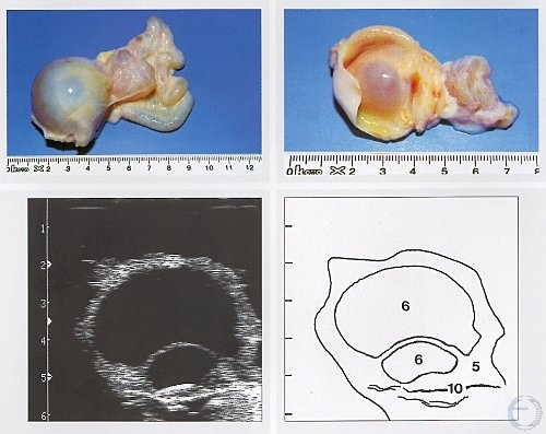 Follicular Cyst and Hydrosalpinx.