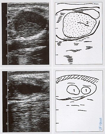 Normal Day 12 Ovarian Sonogram.