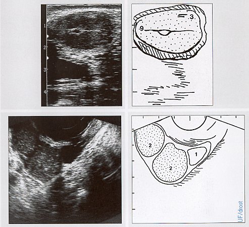 Day 15 Ovarian Sonogram.