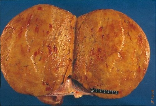 Solid Granulosa Cell Tumor.