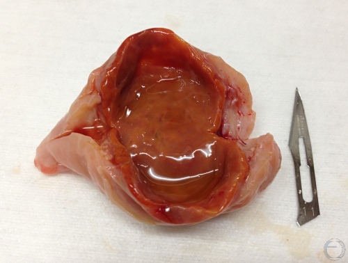 Cavitated Corpus Luteum.