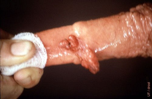 Small Penile Warts.