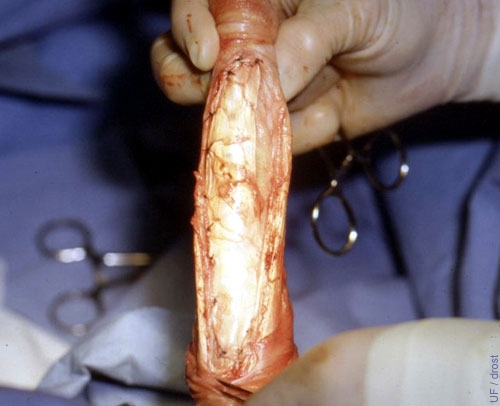 Penis Deviation Correction - Graft Sutured in Place.