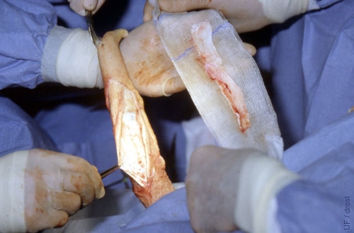 Penis Deviation Correction - Isolated Strip of Fascia.
