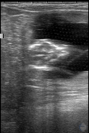 71-Day Fetal Head.