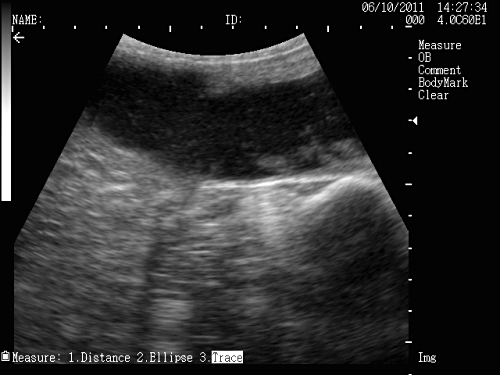 Tritrichomoniasis Abortion.