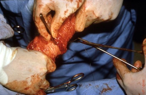 Preputial Surgery - Circumcision 3.