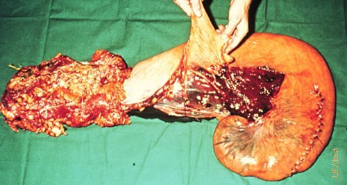 Ruptured Uterine Artery.