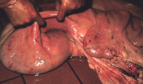 Intussusception of the Tip of the Horn.