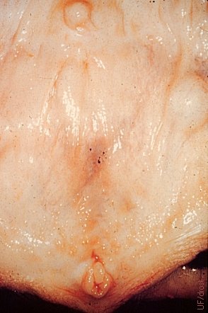 Cystic Vestibular Gland - Small.