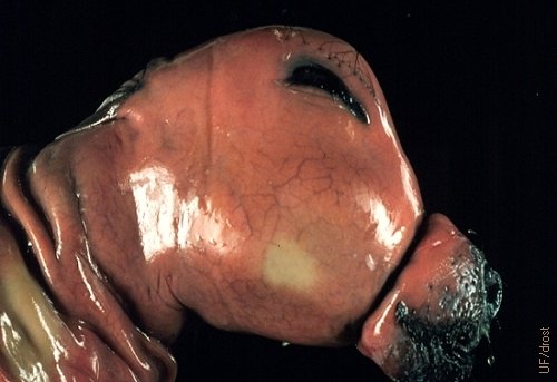 Accidental Fetal Death - Close Up.