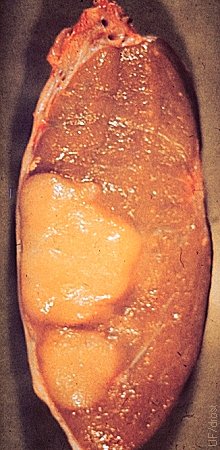 Sertoli Cell Tumor.