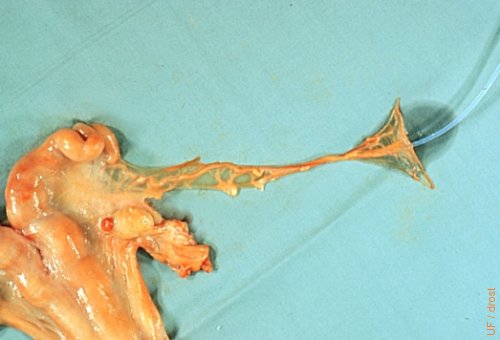 Uterine Tube Dissected Out.