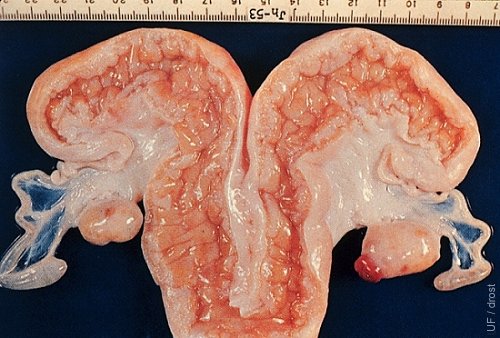 Bilateral Infundibular Aplasia.