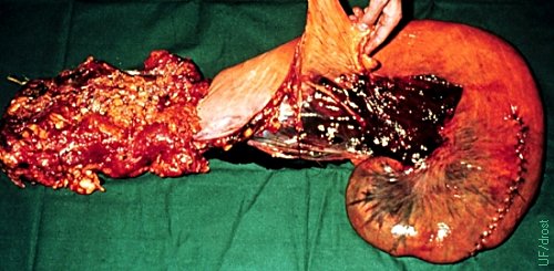 Ruptured Uterine Artery.