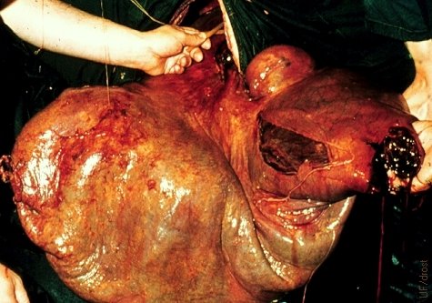 Amputated Uterus.